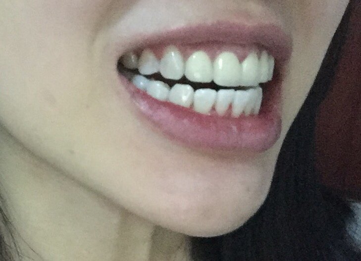 新氧- 氧气633 | 术后当自强 | 冷光美白 | 牙齿 | 牙齿美白 | 国内