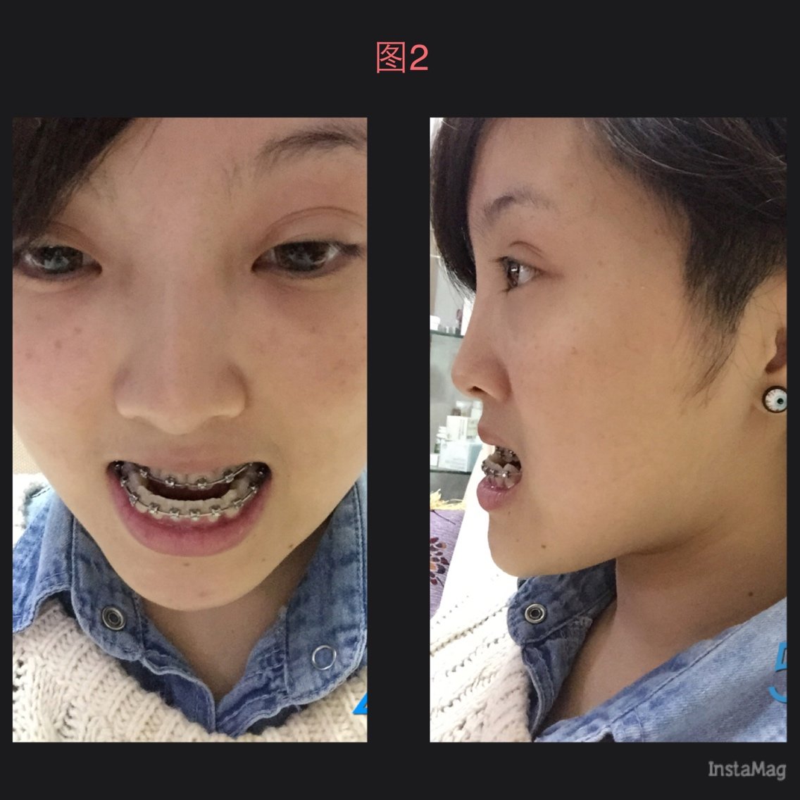 是我现在牙齿正常咬合起来的样子 下牙是不是看上去有点倾斜?