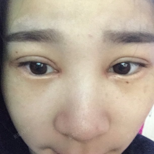 眼睛哭肿了然后就肿成单眼皮并且下垂很严重,嫌难看贴