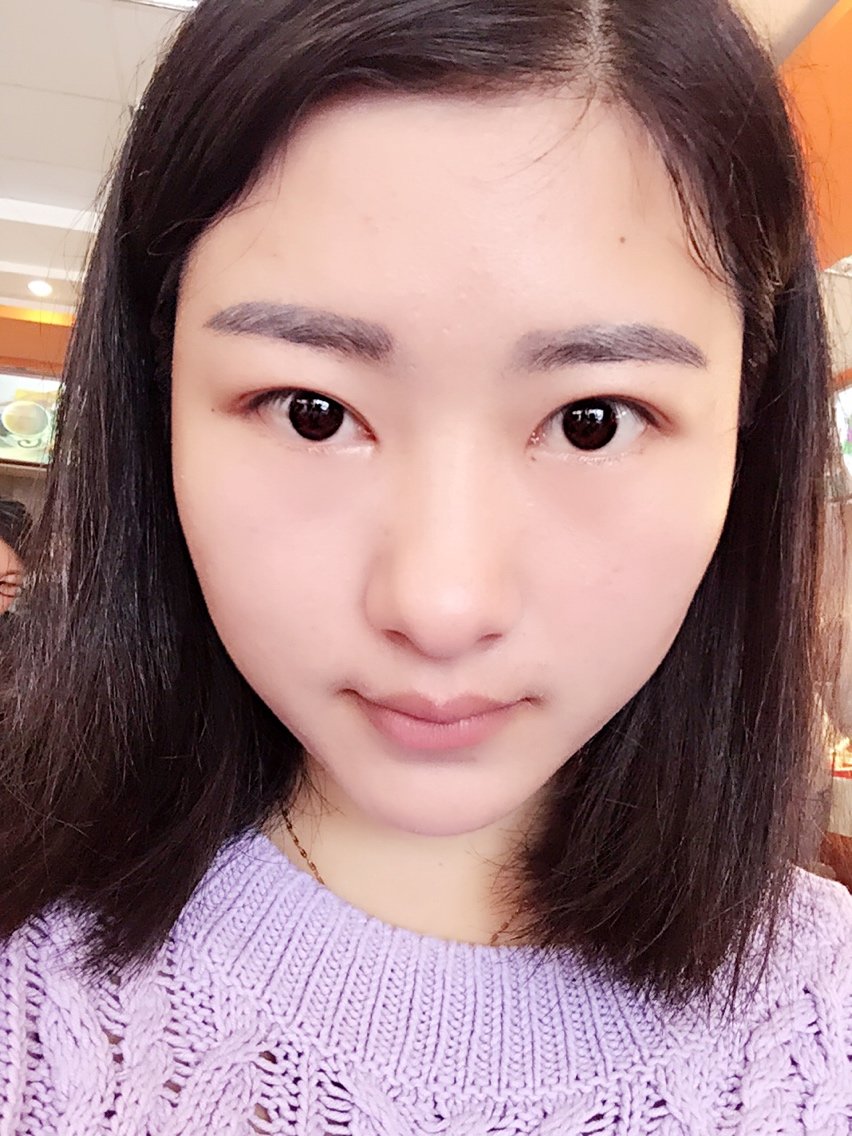 新氧- 泉水girl | 术后当自强 | 韩式三点双眼皮 | 开内眼角 | 眼部