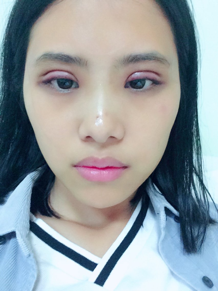 新氧- 氧气56372fd79320d97 | 术后当自强 | 韩式三点双眼皮 | 眼部