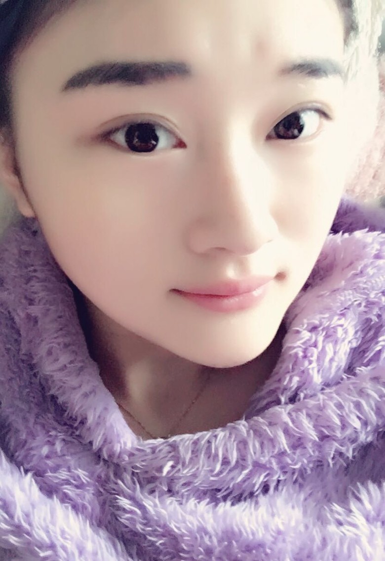 新氧 燕燕燕子 术后当自强 注射肉毒素痩脸(瘦脸针)