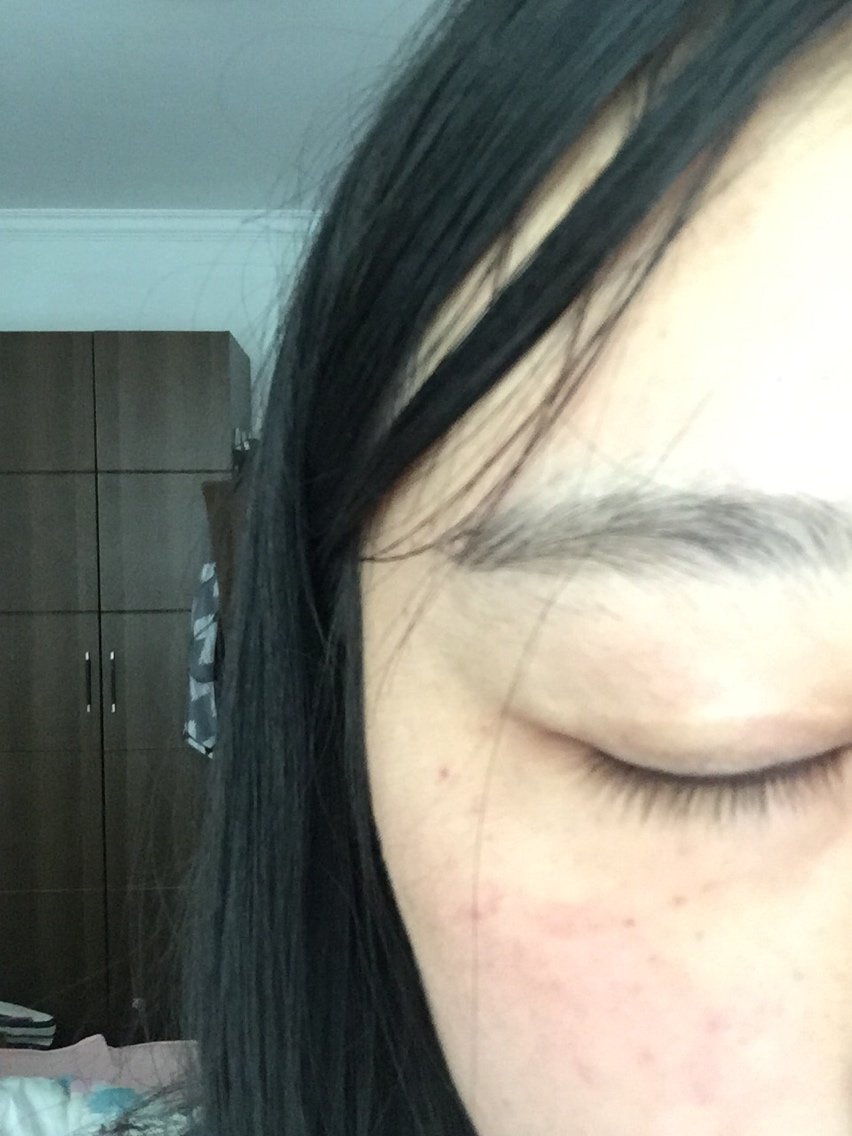 打完了针眼估计要一周左右才能消除掉哦,好多针眼,皮肤看上去有些反光