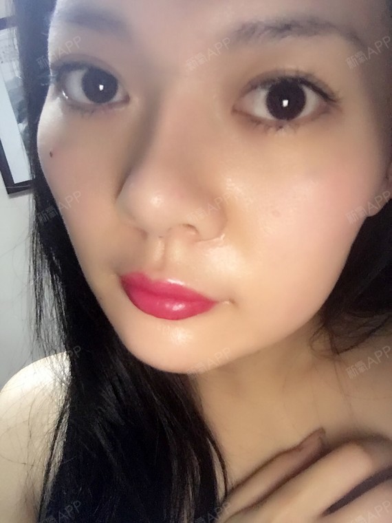 夜里嘴唇出了好多溢液消肿了大半了下唇基本消肿上唇还_圈子-新氧美容