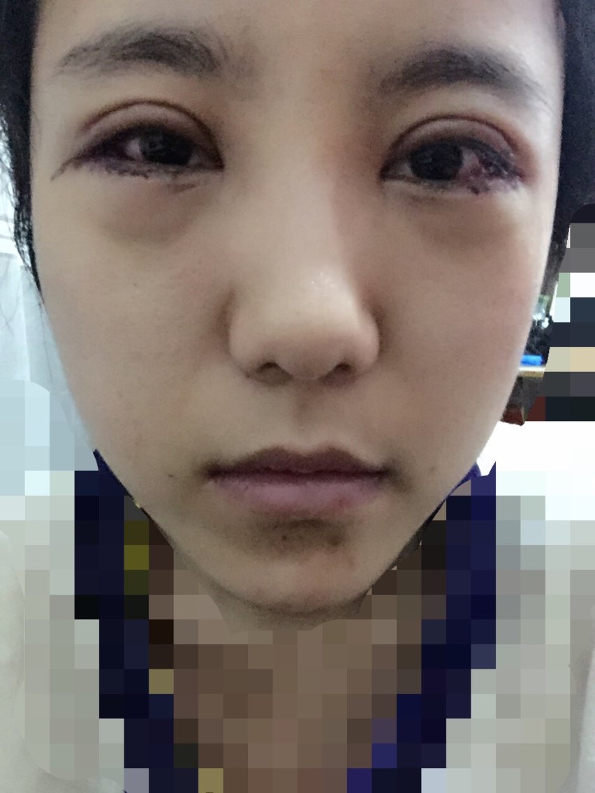 728391 | 术后当自强 | 新氧 | 外眼角下拉
