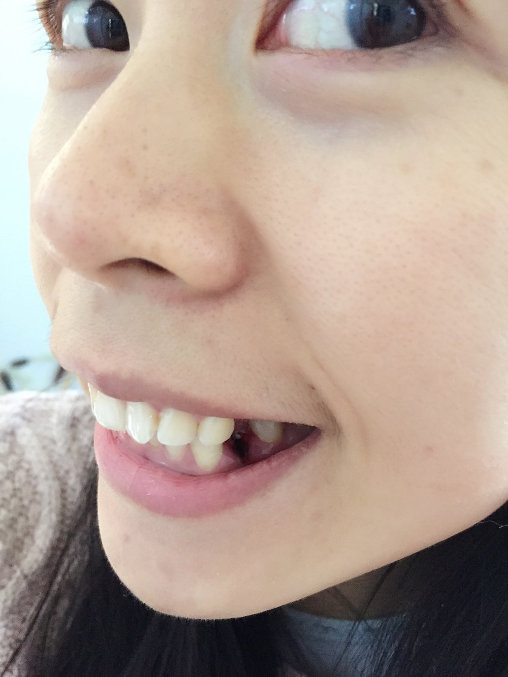 昨天是矫正牙齿的第一天,我是骨性龅牙,不想做手术