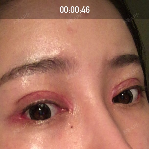都23天了,眼睛每天都红肿的吓人,增生像两条虫子.