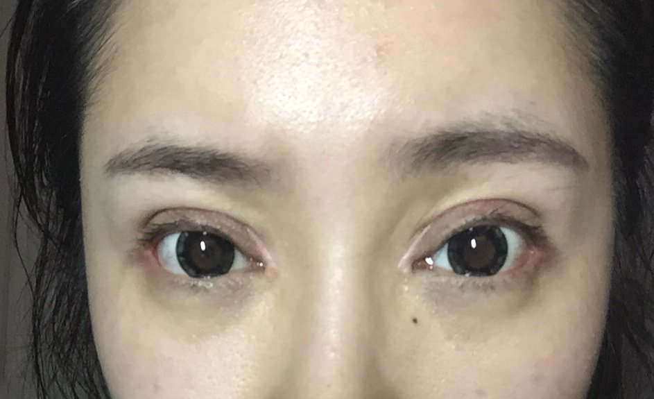新氧- hello-蜜雪儿 | 术后当自强 | 大连同城 | 外眼角下拉 | 眼部