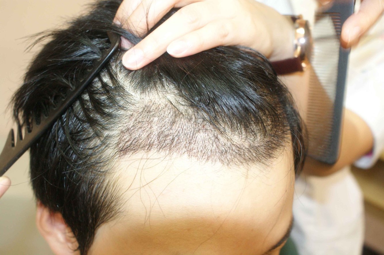 新氧 迷盲 术后当自强 上海同城 毛囊单位移植 毛发 毛发