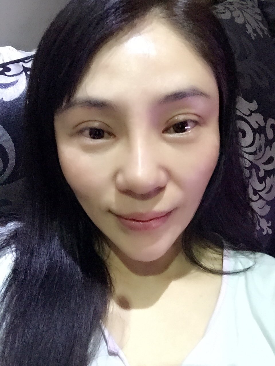 开内眼角怎么样_恢复过程_效果如何_逗逗的豆豆整形12