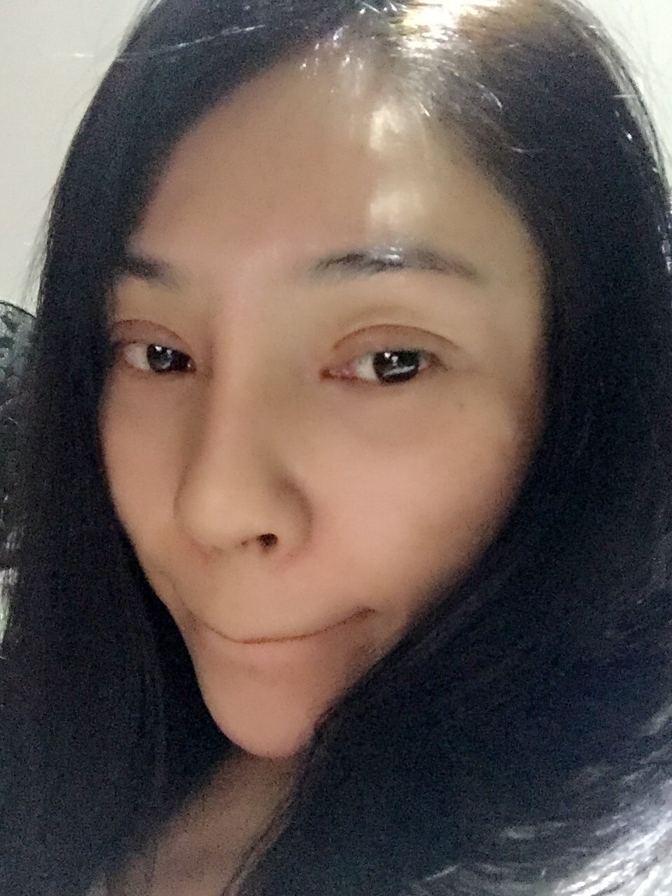 开内眼角怎么样_恢复过程_效果如何_逗逗的豆豆整形12