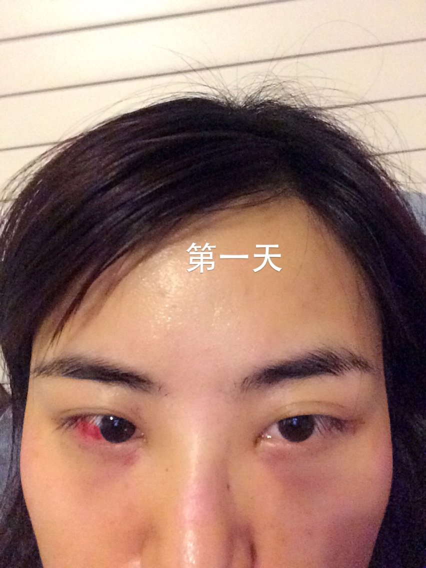 不作不会死内切去眼袋第8天美丽日记-新氧美容整形