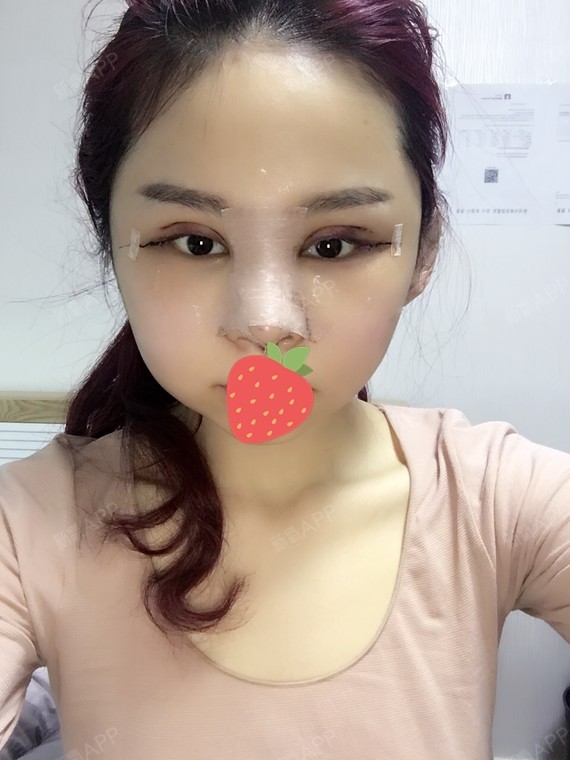 开外眼角好不好_效果图_丶哎哟喂开外眼角术后第3天