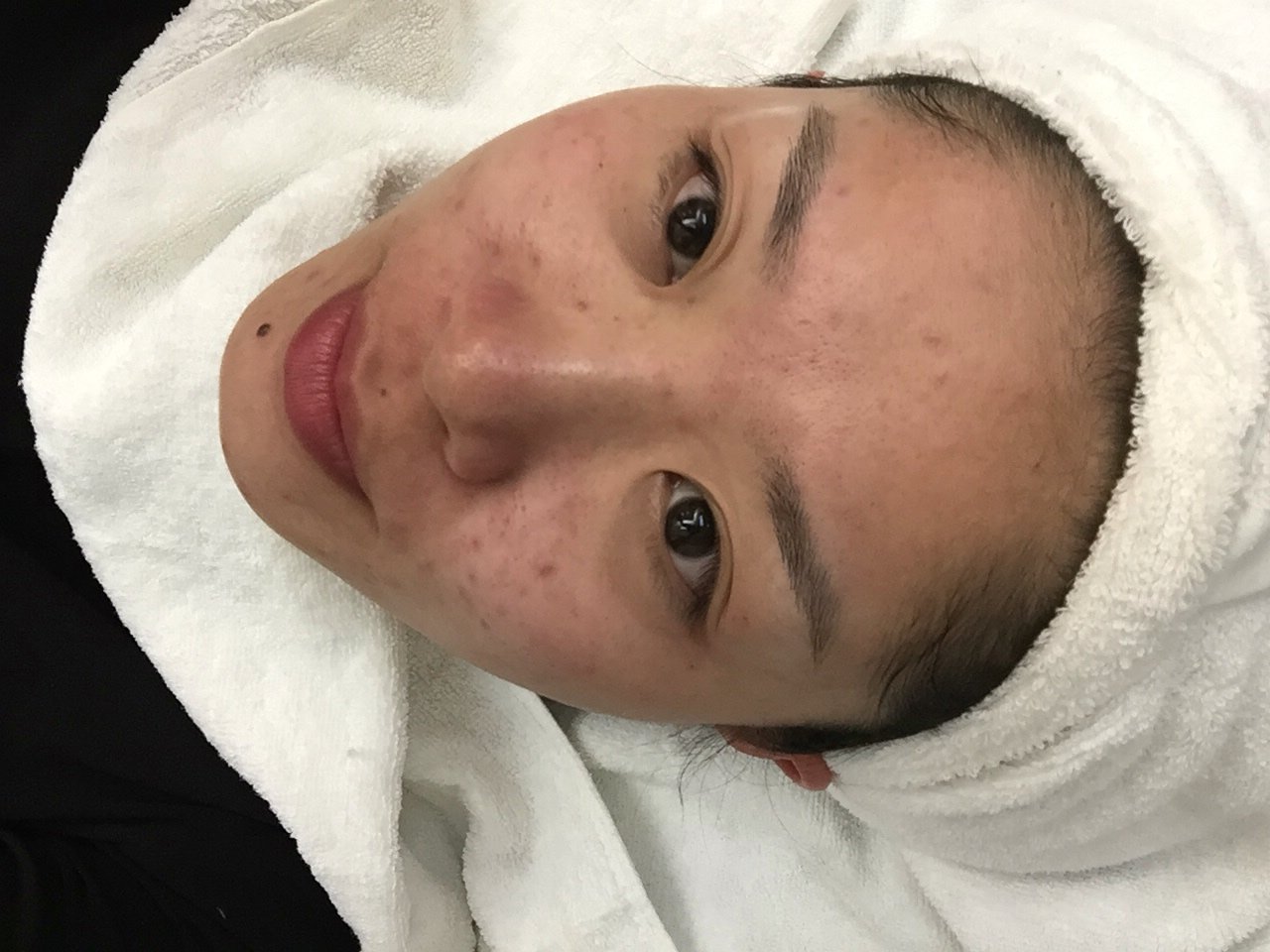 术后当自强 美容美妆 激光美肤 北京同城 黑脸娃娃 改善