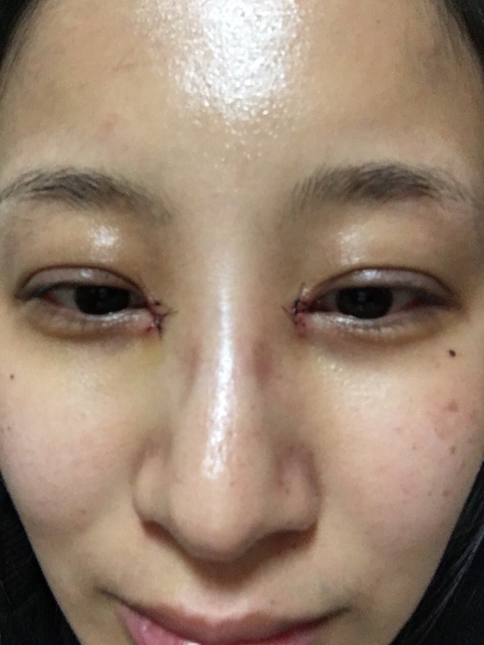 第二次内眼角修复,这次应该是开开了!期待回复!