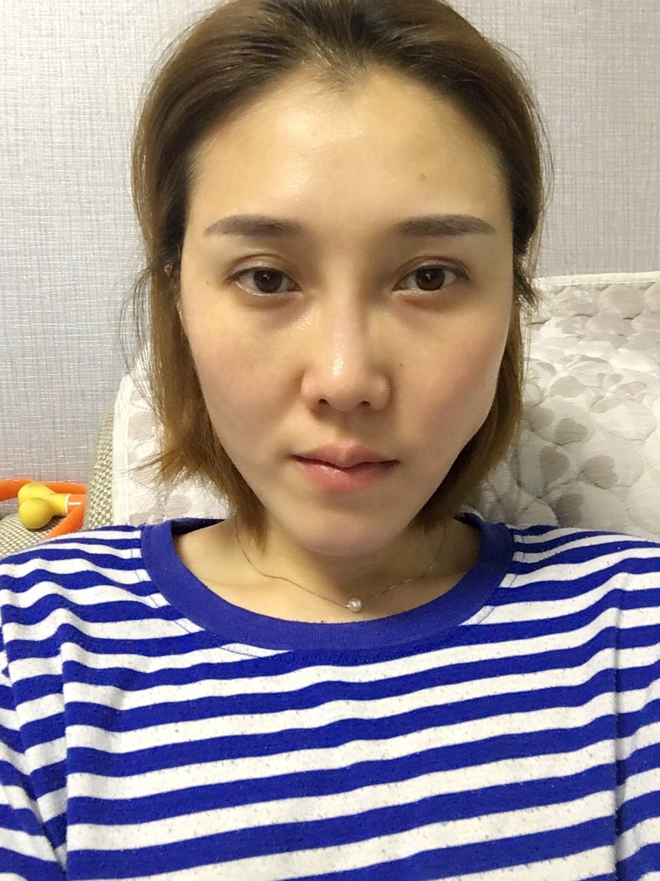 术后当自强 | 新氧 | 注射肉毒素痩脸(瘦脸针) | 面部轮廓 | 注射