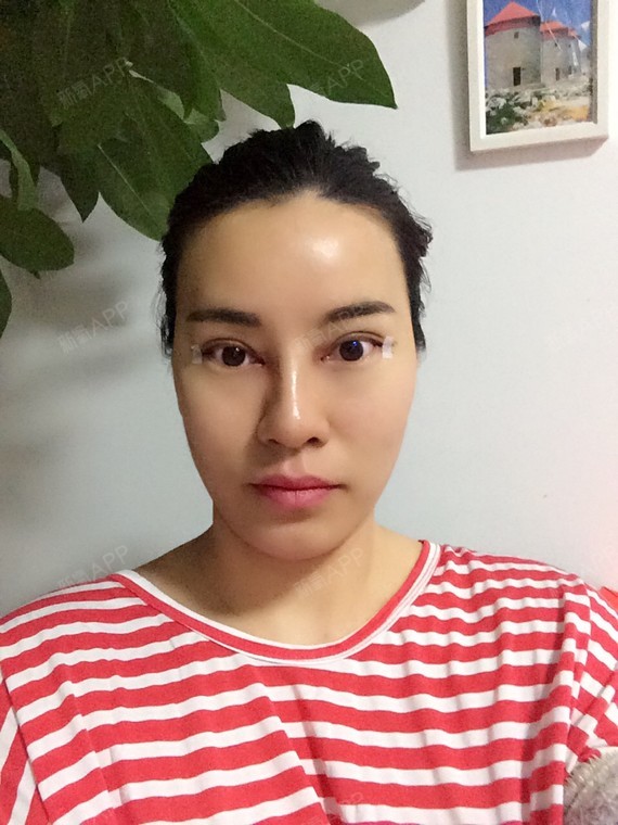 今天做了开内外眼角手术,之前眼角上翘,没有精神,只_圈子-新氧美容
