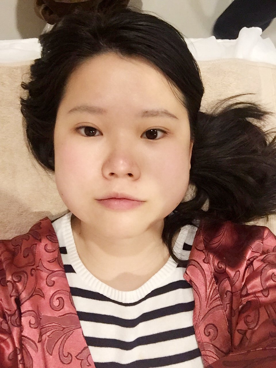 新氧- cecewency | 术后当自强 | 新氧 | 注射溶脂针 | 面部轮廓