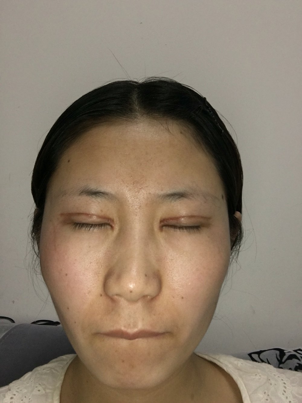 本来就吊眼梢眼尾就高,双眼皮形态眼尾还挑那么高