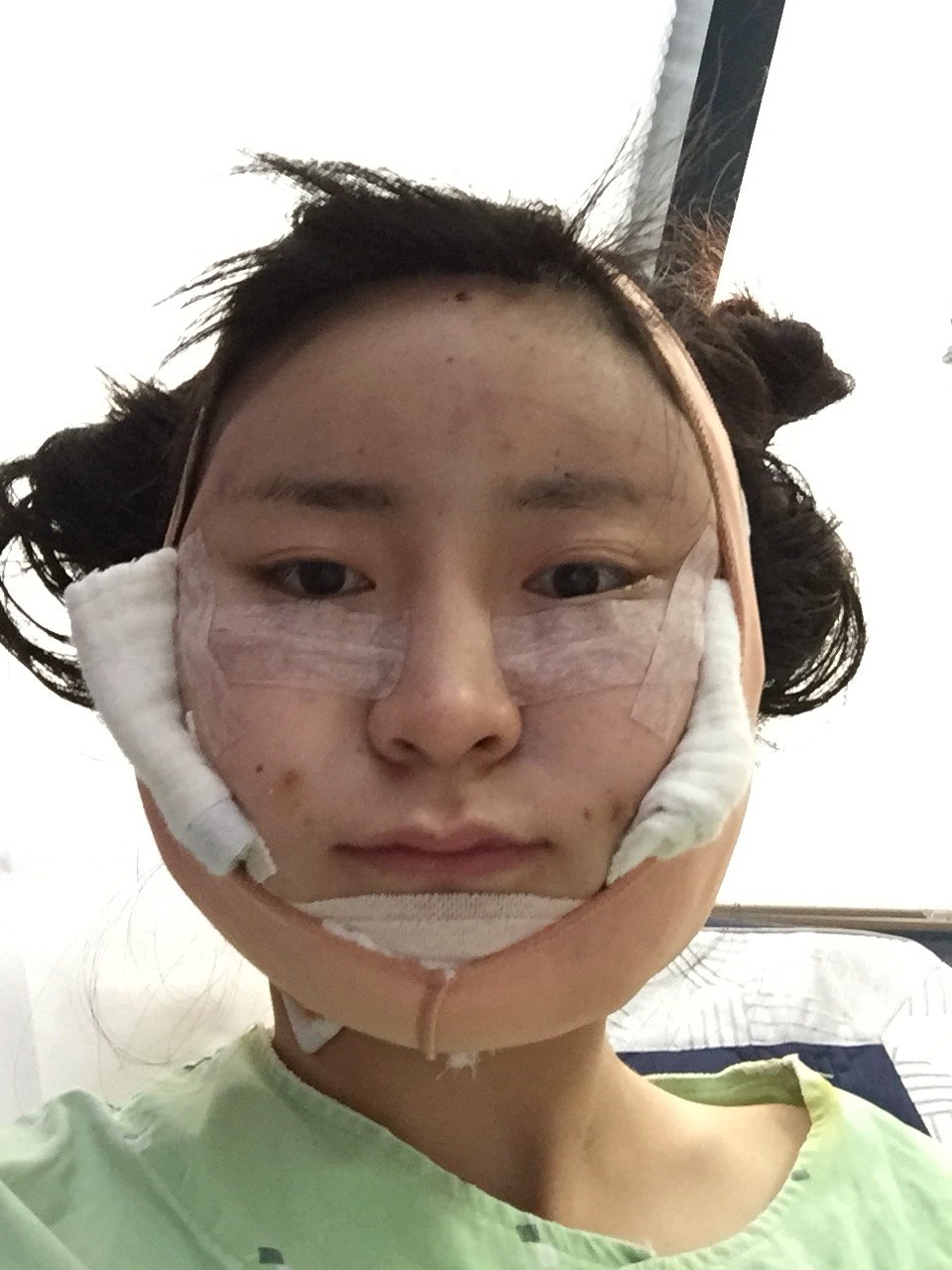 我摸了一下,真的没有骨头了,我一直想让消失的颧骨真的没有了,下颚角