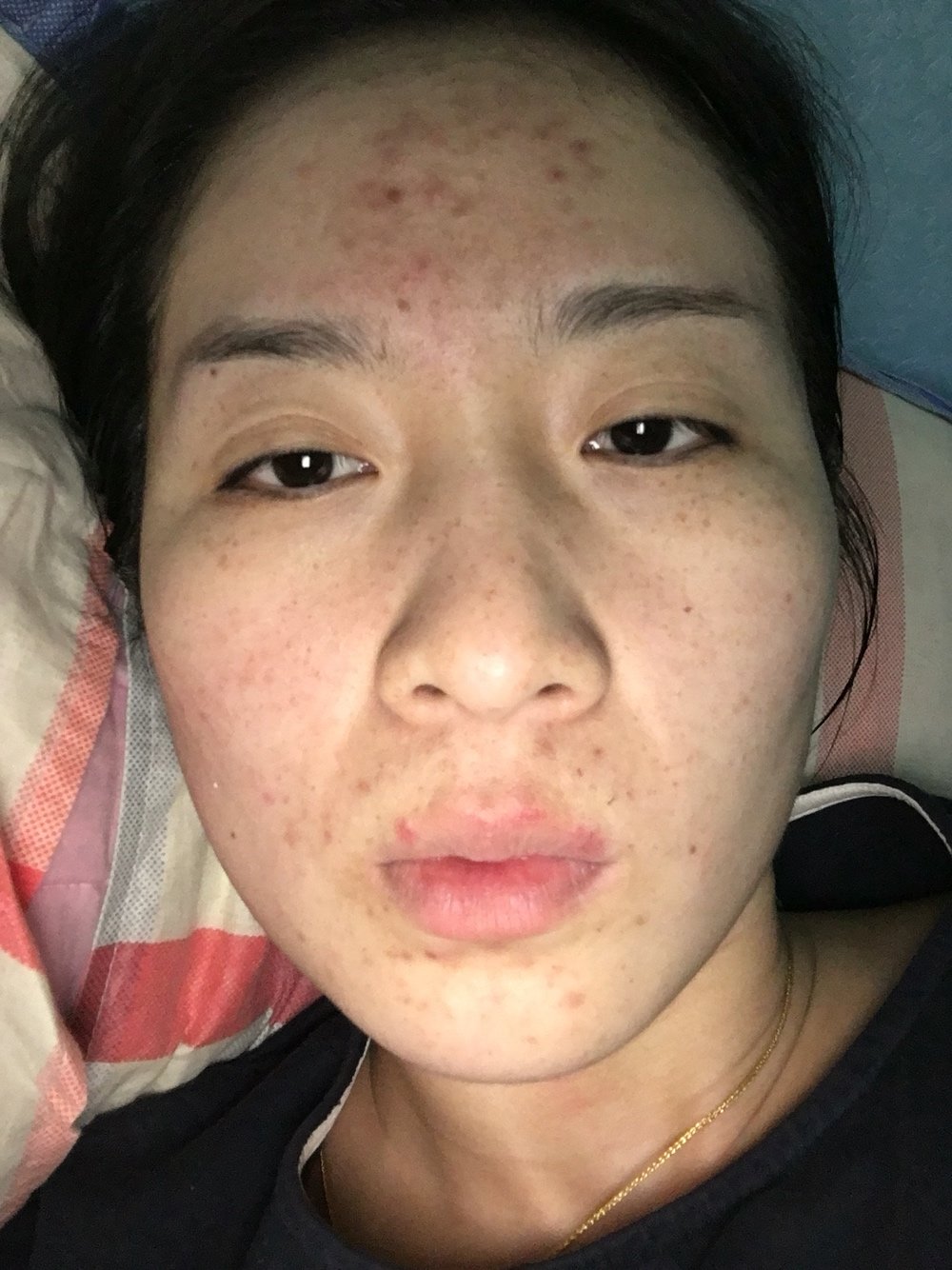 做光子嫩肤之前,每天早晚各一贴面膜,感觉脸上皮肤明显白了,但是一旦