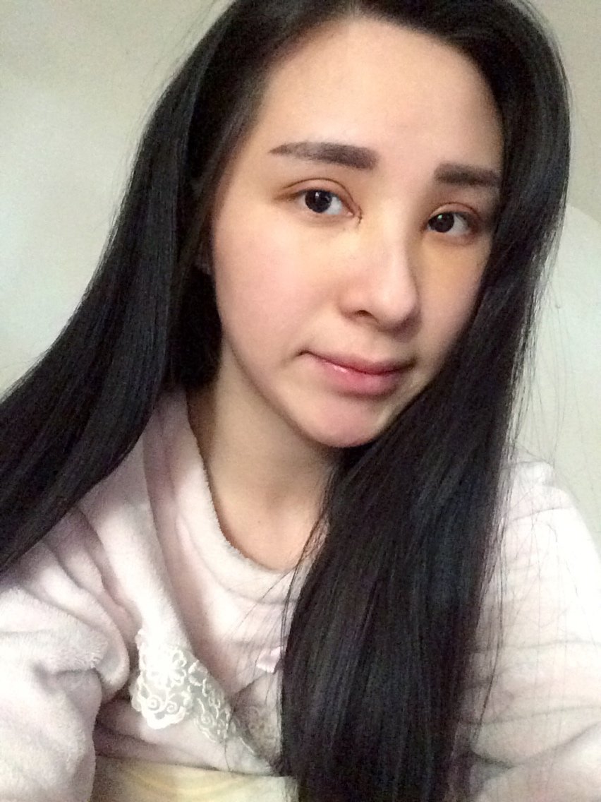 武汉中爱铭医医疗美容开内眼角怎么样_恢复过程_效果