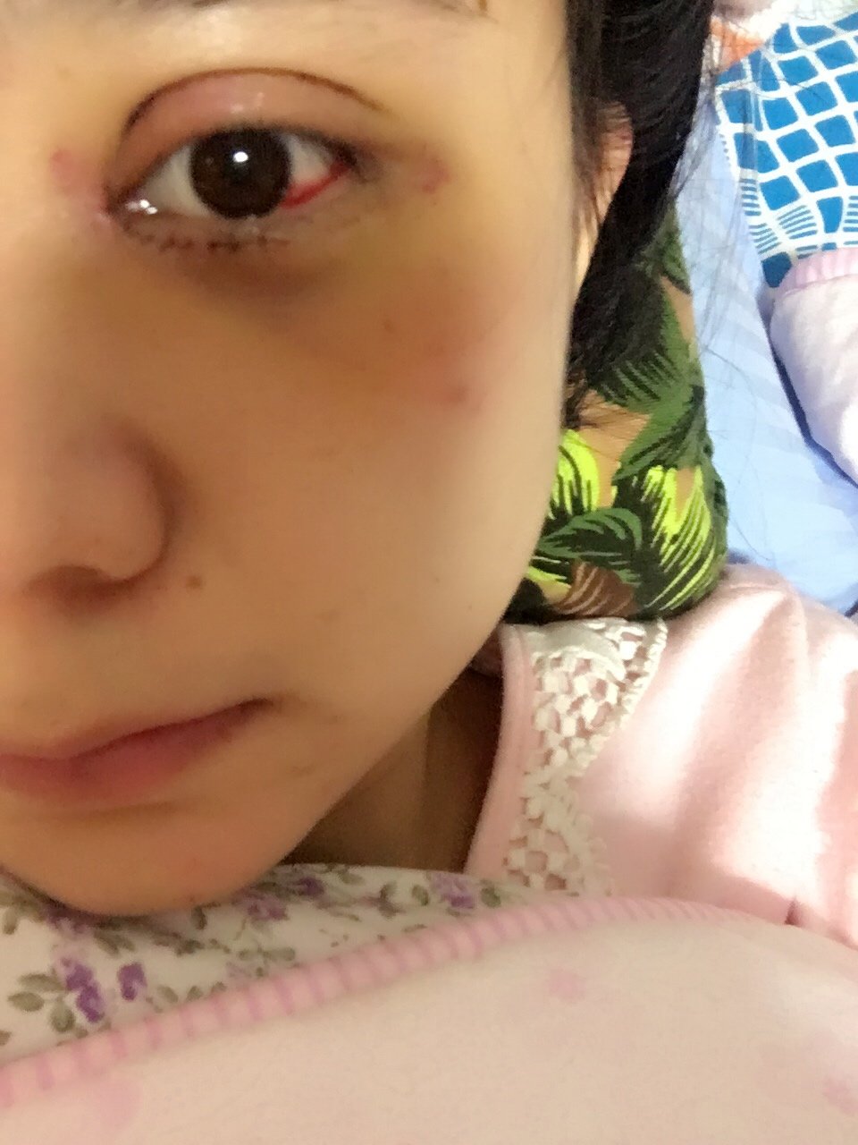 眼睛周围开始发黄,眼皮也没那么紫了,有点好转