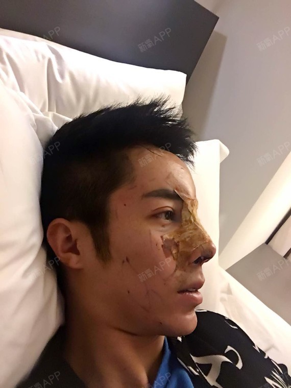 刘泽雨鼻部修复第29天美丽日记-新氧美容整形