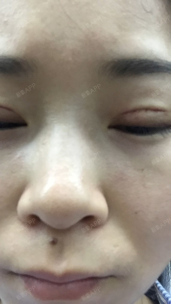 而且医生说我眼睛还是有些肿.