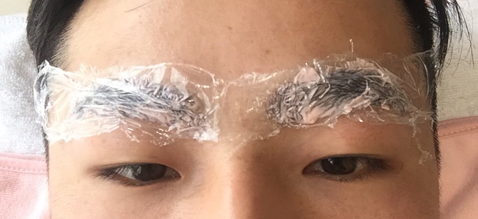 手术基本没什么感觉,术后会有一点疼痛感～这里的麻药和纹眉刀都是