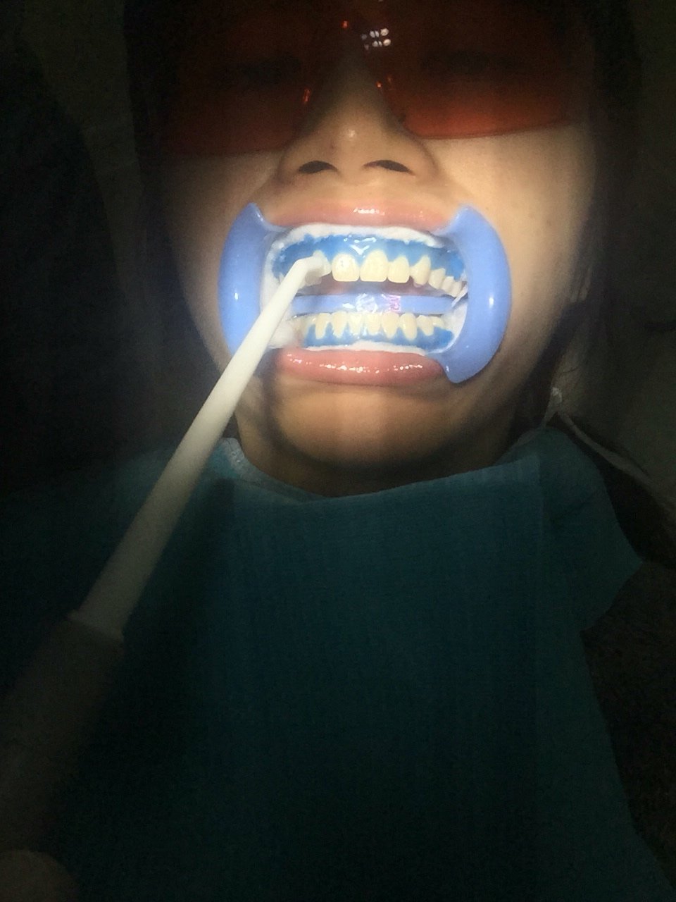 我2月16号的时候第一次做牙齿冷光美白,那时候做完效果很好,而且全程