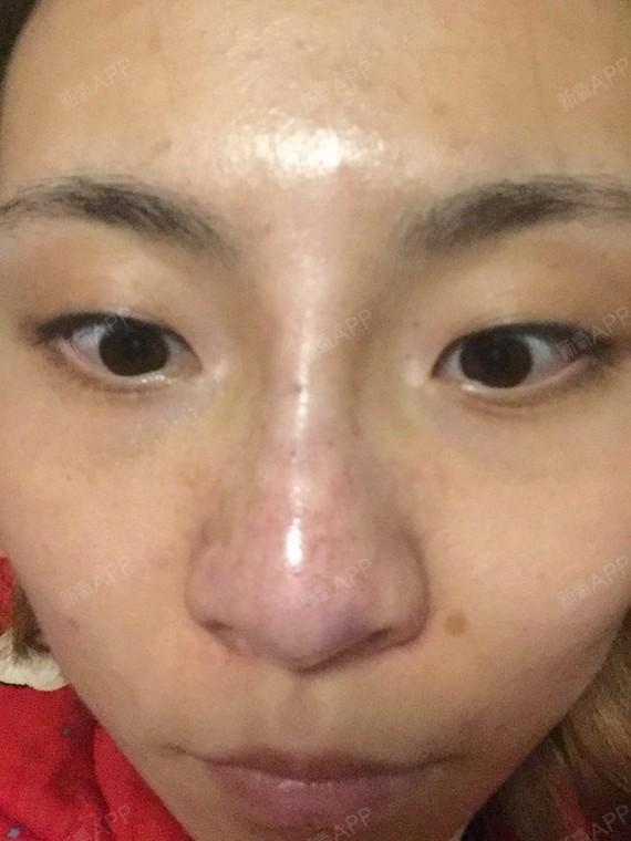 玻尿酸隆鼻,排异了吗这是?连脸部皮肤都感觉有红血丝出来?