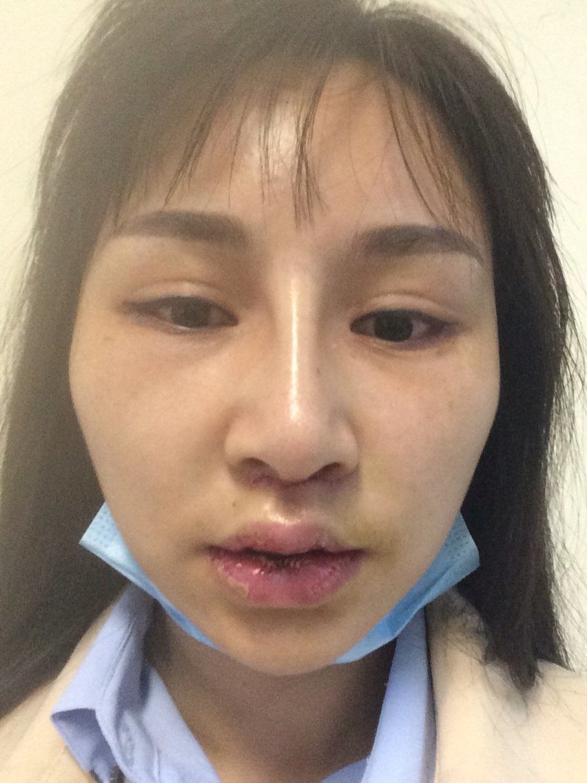 自体脂肪丰唇第8天