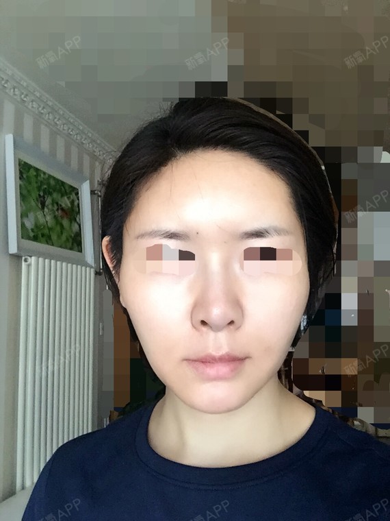 我的额头比较窄,也不丰满,太阳穴凹陷,脸颊两侧也有_圈子-新氧美容