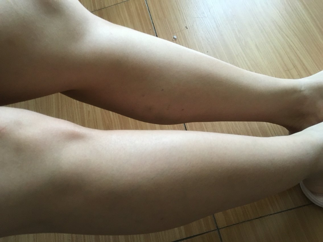 肉毒素瘦小腿