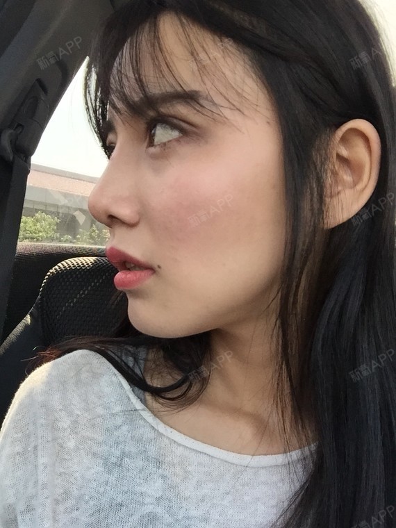 泡泡是条鱼驼峰鼻矫正第42天美丽日记