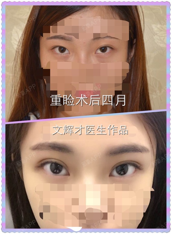 重睑切开术式:平扇形8毫米