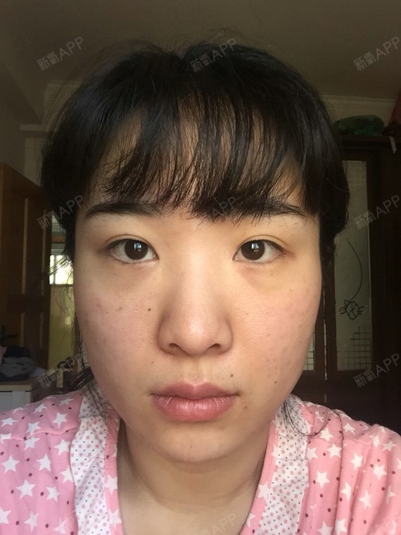 新氧-姣姣_580246|术后当自强|大连同城|肉毒素瘦脸|肉毒素跑步燃烧脂肪图片