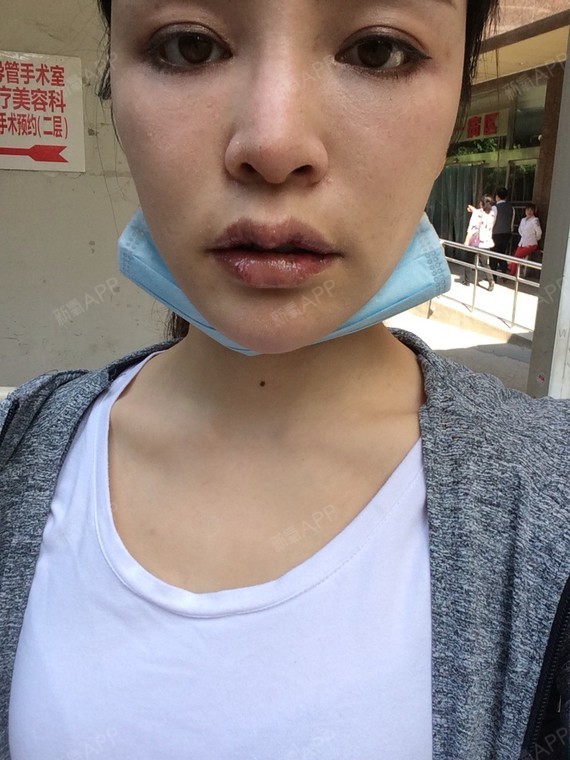 m唇手术好不好_效果图_氧气_h4gq445c6m唇手术术后第6天_新氧美容整形