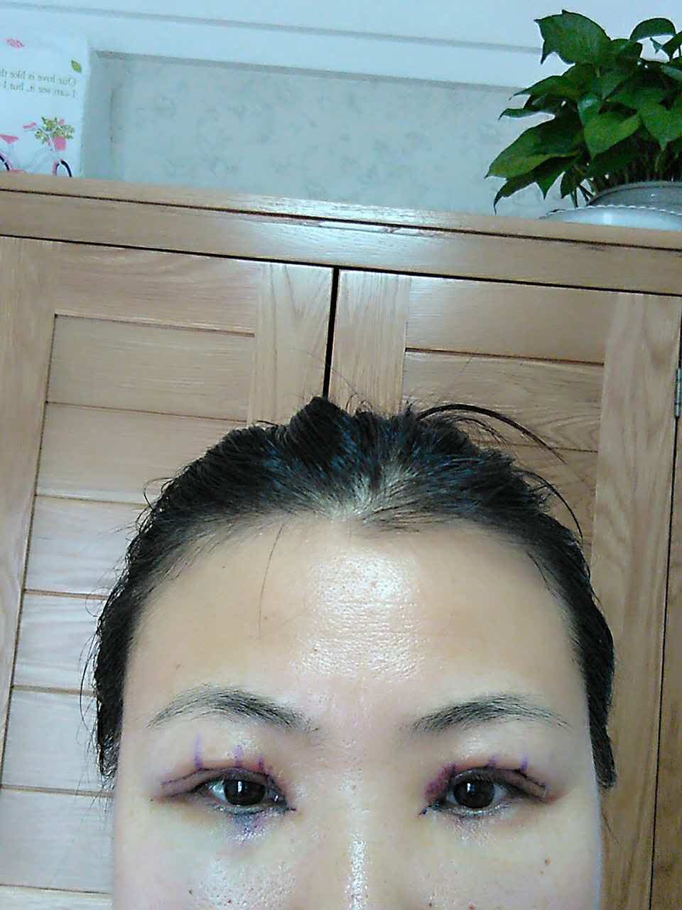 开内眼角第2天