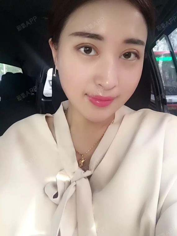 新氧- michelle995 | 眼部 | 开眼角 | 双眼皮 | 开内眼角 | 切开双