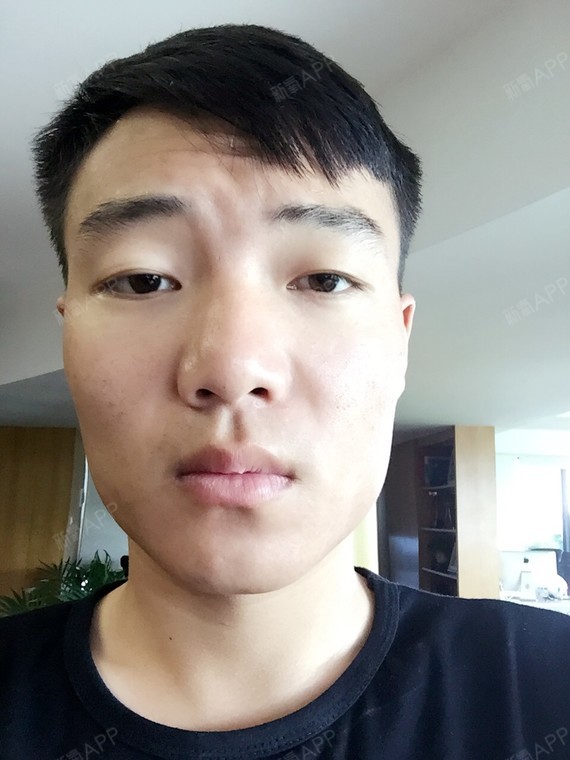 效果非常好咬肌变软了期待后面的效果