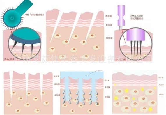 微针疗法美容刺激真皮层的伤口自愈能力,从而刺激皮肤,促进骨胶原增生