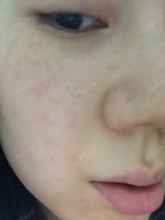假体隆鼻后满脸起小疹子是过敏吗?