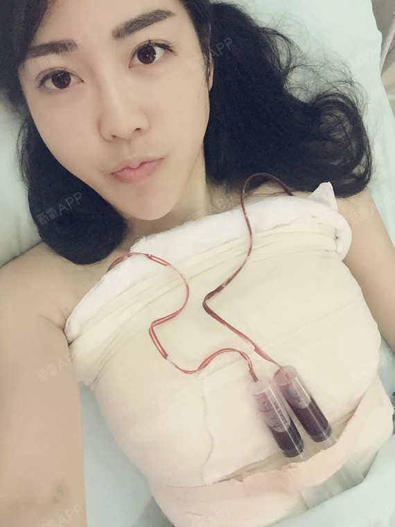隆胸300cc效果图,假体隆胸700cc真人图片 终于鼓足勇气来重庆做假体,在心氧上面跟重_圈子-新氧