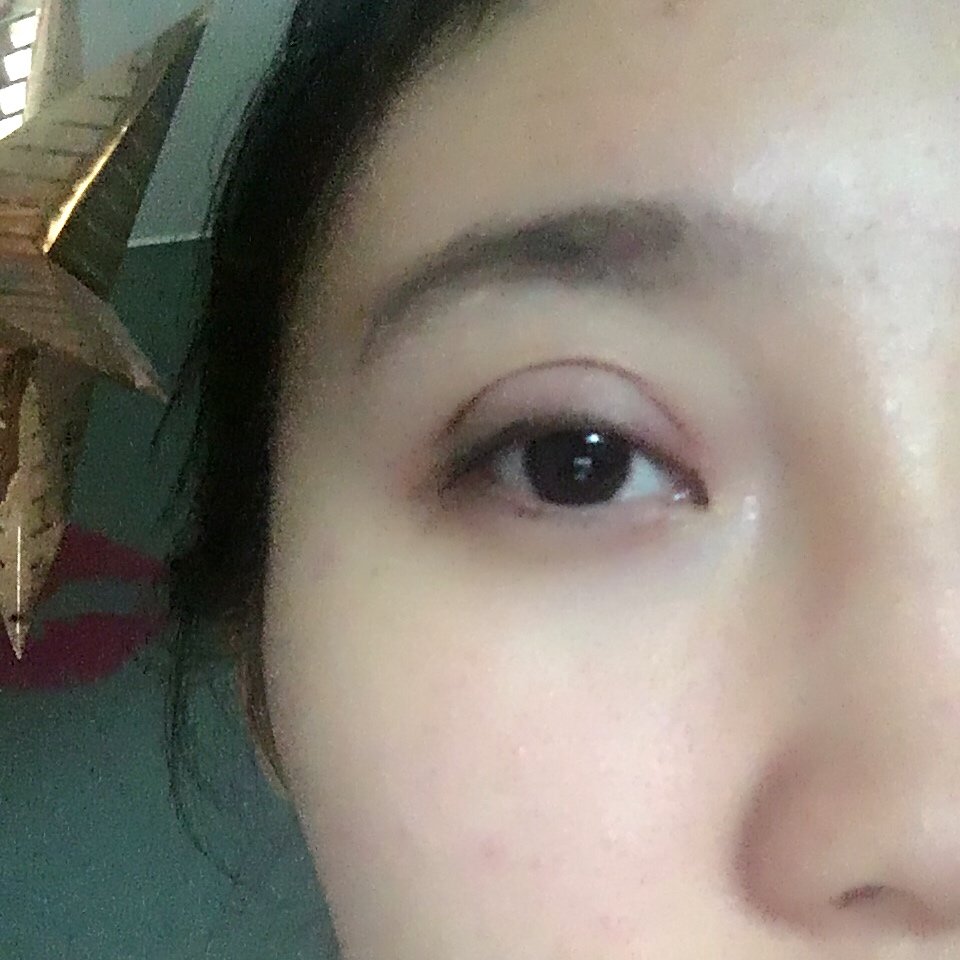 埋线双眼皮第0天