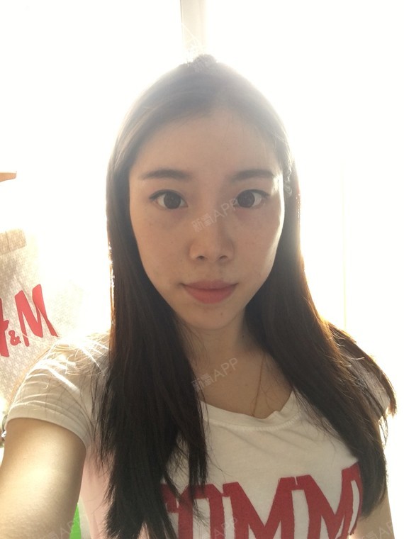 打造甜美少女系,深圳弘美整形医院免费招募代言人,新氧昵称:我不是大