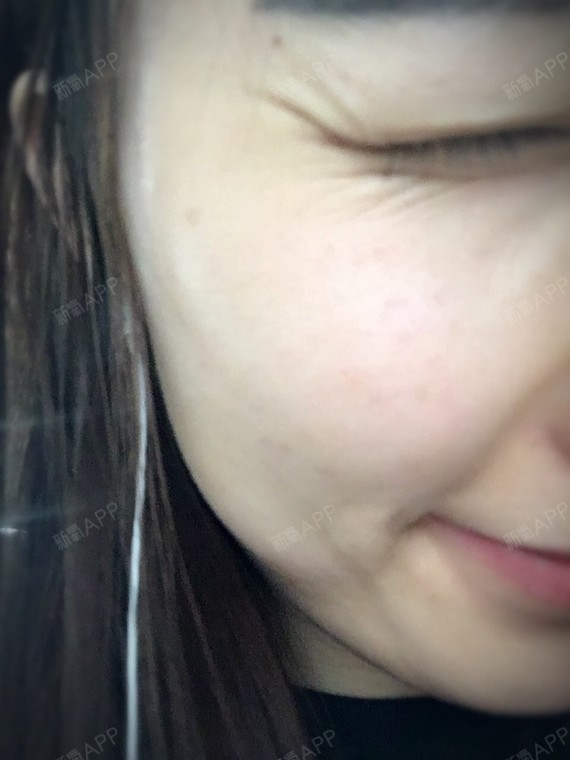 才25岁,不笑还好,一笑眼角有很深的笑纹,能去除吗,怎么去?