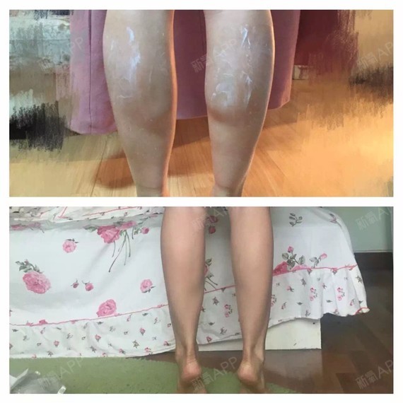 肉毒素瘦小腿