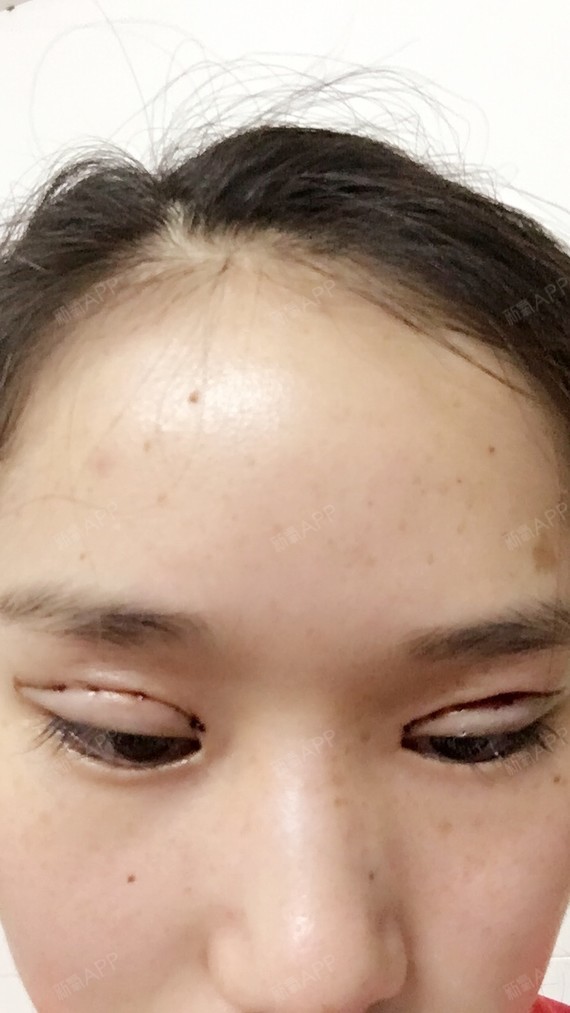 化妆造型师suki_558511定点双眼皮术后第天美丽日记_新氧整形